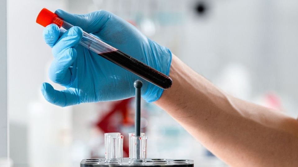 How Long Does Adderall Stay in Your System Urine, Blood, Saliva, and Hair heo image of someone preforming a blood drug test.